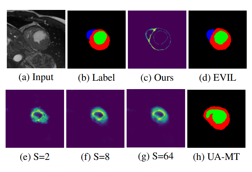 EVIL: Evidential Inference Learning for Trustworthy Semi-supervised Medical Image Segmentation