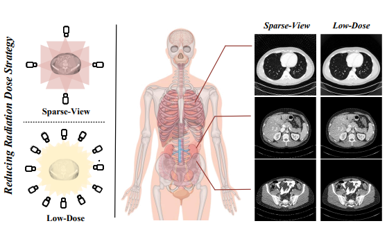 Patient-Level Anatomy Meets Scanning-Level Physics: Personalized Federated Low-dose CT Denoising Empowered by Large Language Model